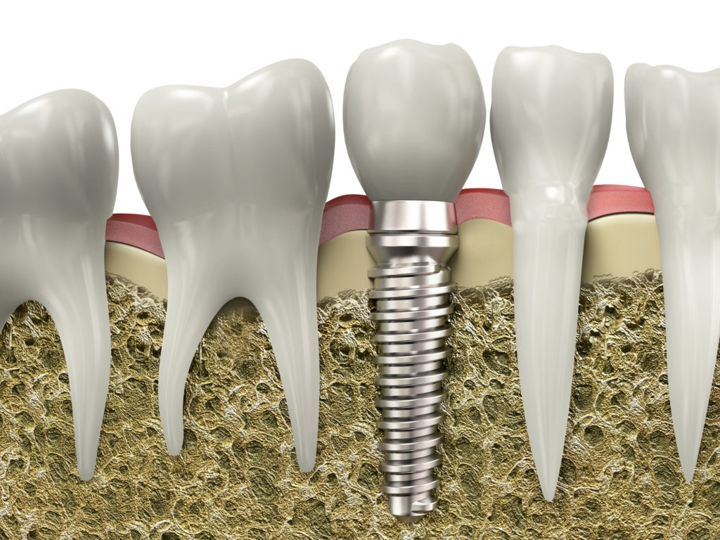 who offers the best dental implants boynton?